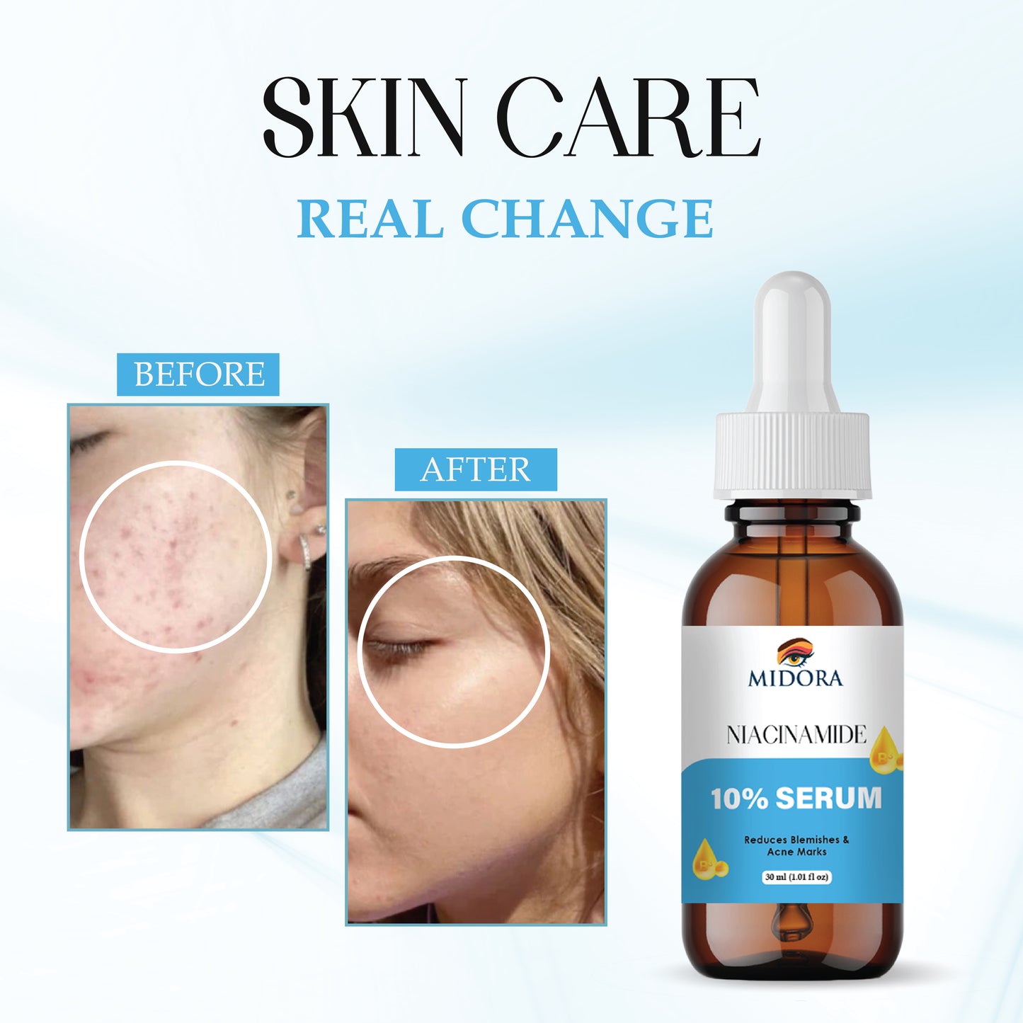Niacinamide Serum for Face | 10% Niacinamide + Zinc | Oil Control, Acne Marks & Pore Minimizer | Skin Brightening & Hydrating Face Serum for Men & Women