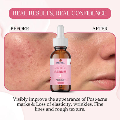 Alpha Arbutin Serum for Dark Spots & Pigmentation | Skin Brightening & Even Tone | Face Serum for Glowing Skin | Suitable for All Skin Types – 30ml